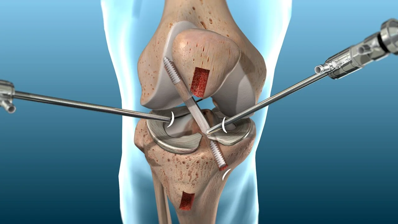 Sports injury treatment - Ligament repair and ACL reconstruction at Bafna Clinic Mumbai