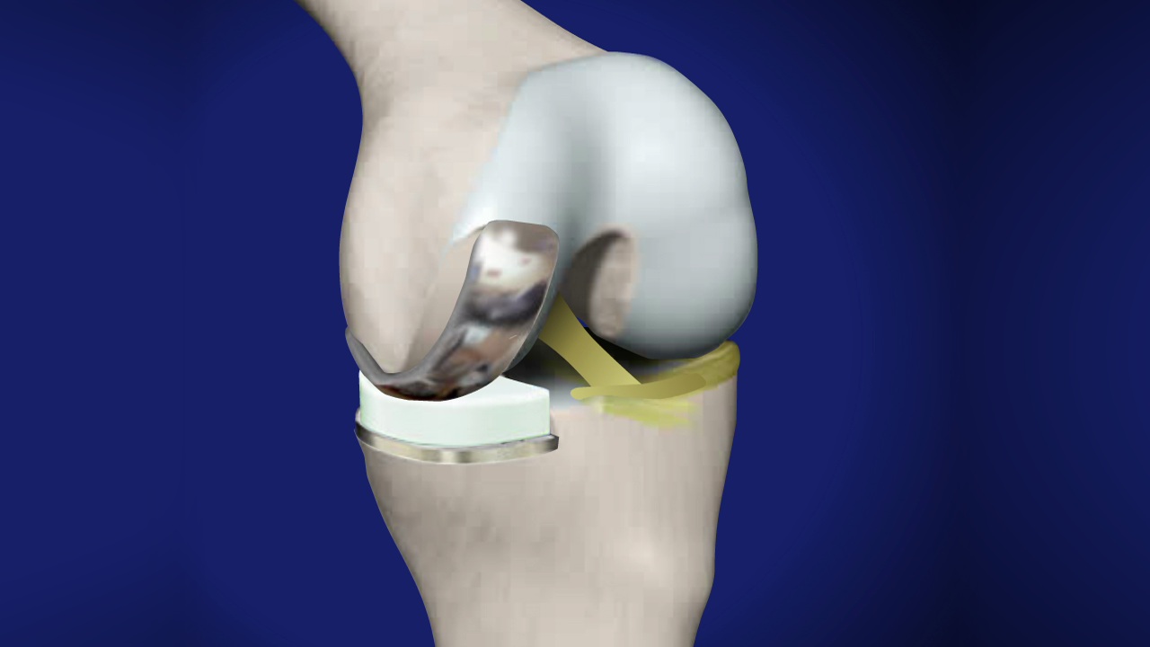 Partial Knee Surgery